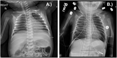 Recurrent and Sustained Viral Infections in Primary Immunodeficiencies